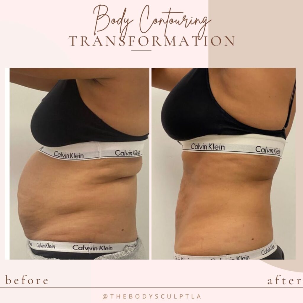 Our Before & After Body Sculpting Results in LA