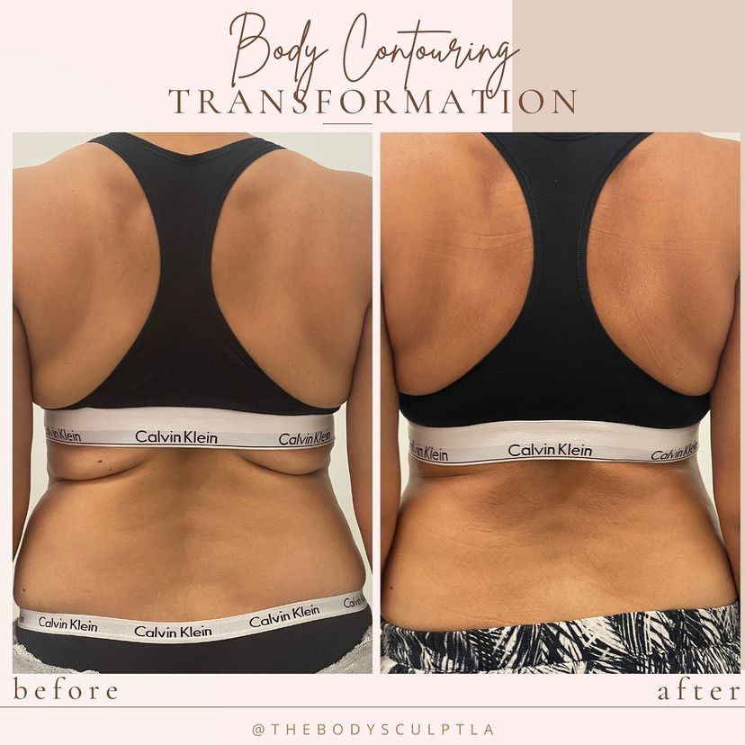 Our Before & After Body Sculpting Results in LA